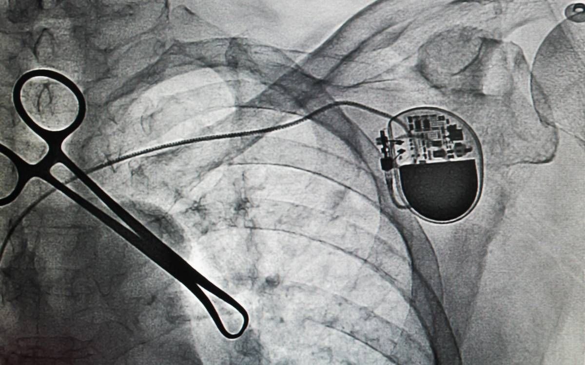 Cirugía de Marcapasos: Todo lo que Necesitas Saber sobre el Procedimiento y Cuándo se Realiza